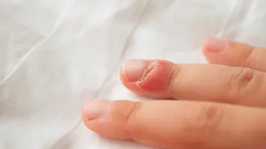 Que faire en cas de panaris ?