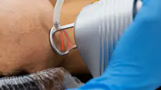 Le laser fractionné ou laser CO2 permet d'enlever les taches brunes sur la peau