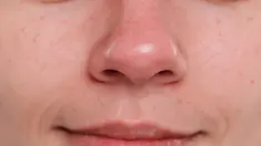 Comment ne plus avoir le nez rouge quand il fait froid ?