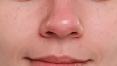 Comment ne plus avoir le nez rouge quand il fait froid ?