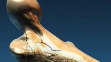 L'ostéoporose, entre méfiance et méconnaissance