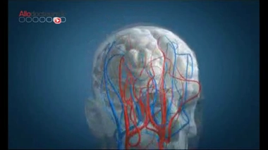 AVC : les premiers signes qui doivent alerter