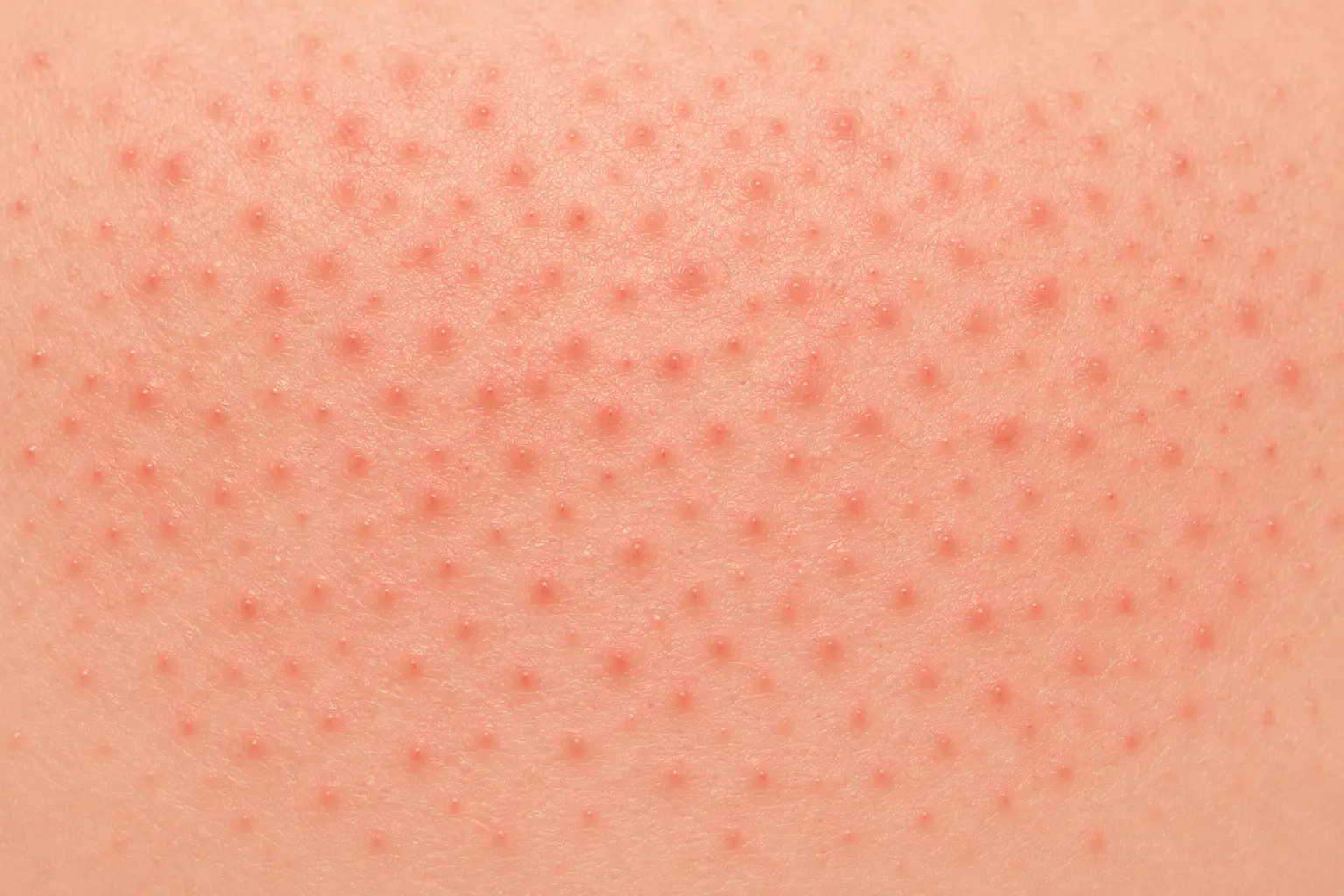 Kératose pilaire 