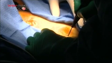 Cancer du côlon : nouveaux essais sur les souris