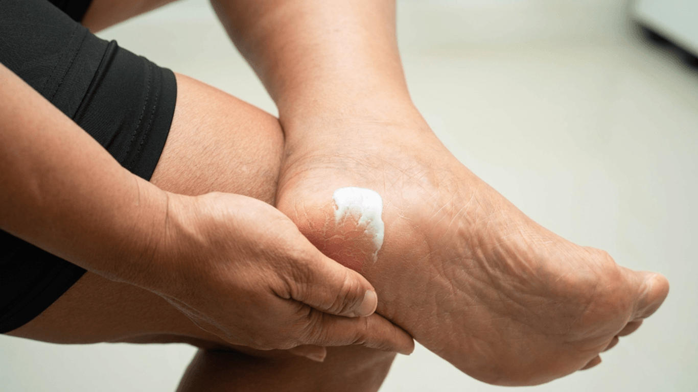 Vous avez les pieds secs et cornés après l'été ? Voici ce qu'il faut faire !