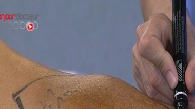 Sarcome : un nouveau traitement de radiothérapie à l’essai