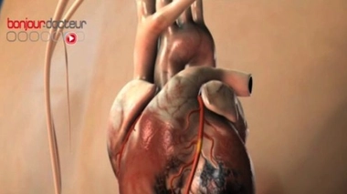 Maladies cardiovasculaires :  prévenir les risques à long terme