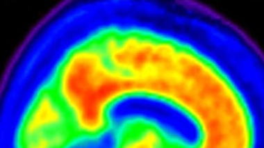 Alzheimer : des recherches… et des vaccins ?
