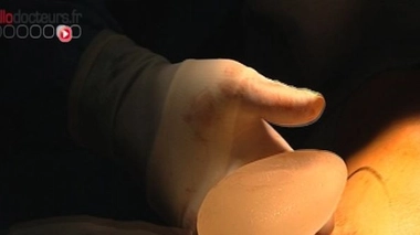 Prothèses PIP : des résultats de plus en plus inquiétants