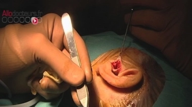 Tympan abîmé : pensez à la greffe !