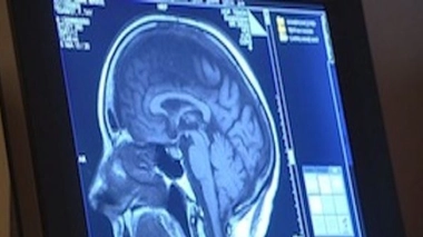 Traumatisme crânien, coma : qu'est-ce que l’échelle de Glasgow ?