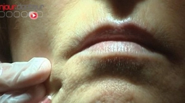 Chirurgiens-dentistes : injections antirides autorisées… dans certains cas