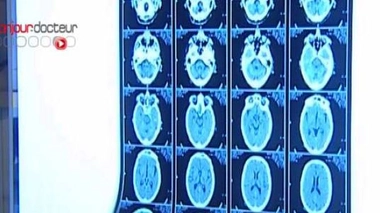 Près de 11% d'hospitalisations de plus pour AVC en France