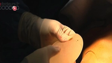 Prothèses PIP : retrait effectué pour une porteuse sur cinq