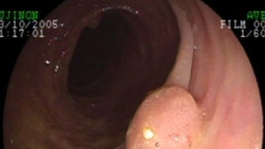 Un nouveau test prédictif du cancer colorectal