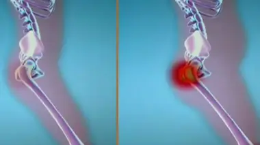 Quelles différences entre l'arthrose et l'arthrite ?