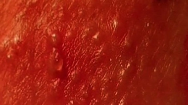 L'eczéma est souvent d'origine allergique