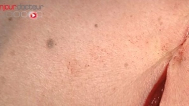 Cicatrices et cicatrisation