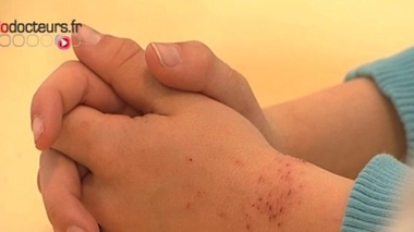 -Exclu- L'eczéma : une maladie très stigmatisante chez les ados