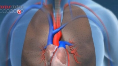 Le plus petit coeur artificiel jamais implanté