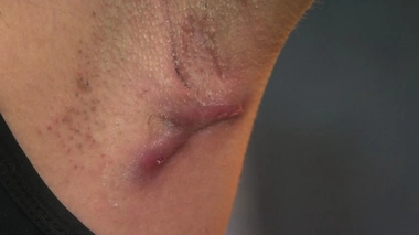 Maladie de Verneuil : une pathologie dermatologique invalidante