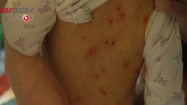 La varicelle gagne du terrain