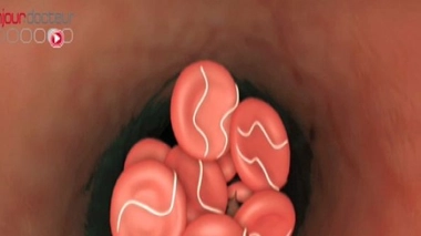 Un nouveau dispositif pour prévenir les AVC ischémiques