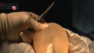 Prothèse PIP : déjà près de 8 000 retraits