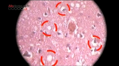Creutzfeldt-Jakob : la variante de la maladie fait une nouvelle victime