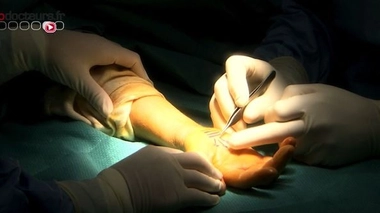 Soigner le syndrome du canal carpien