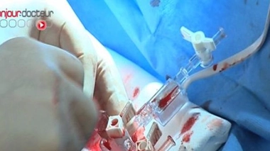 Un nouveau stent biodégradable