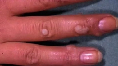 Un produit contre les verrues retiré de la vente