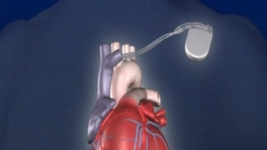 Sondes cardiaques : les porteurs de pacemakers doivent-ils s’inquiéter?