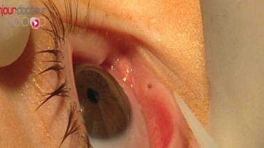 Etats-Unis : nouvelle indication pour le Lucentis®