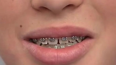 L'orthodontie des enfants