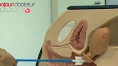 Cancer du col de l'utérus