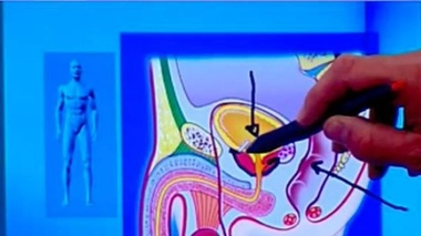 Prédire le risque d'impuissance suite à un cancer de la prostate ?