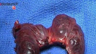 Une thyroïde fabriquée à partir de cellules souches