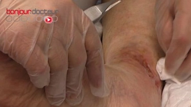 Un caleçon ''électrique'' pour lutter contre les escarres