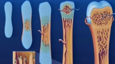 Ostéoporose : pour une meilleure prise en charge