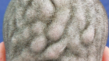 Un Brésilien atteint d'une déformation rare du cuir chevelu