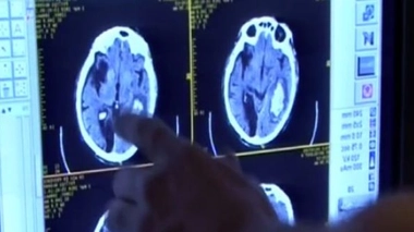 AVC : les femmes principales victimes mais oubliées de la recherche