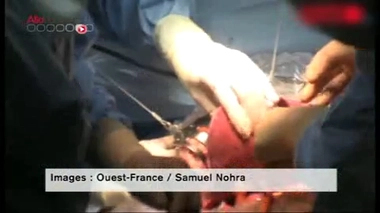 Opérer un cancer du foie hors du corps