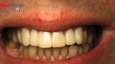 Le déchaussement des dents