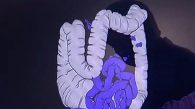 Le cancer colorectal