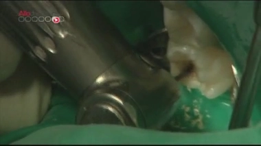 Le mercure dentaire a du plomb dans l'aile