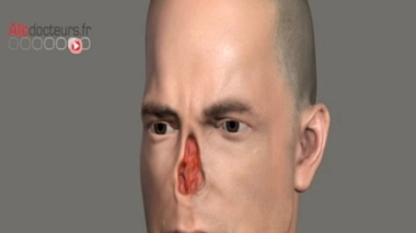 Naissance d'un nouveau nez... sur un bras