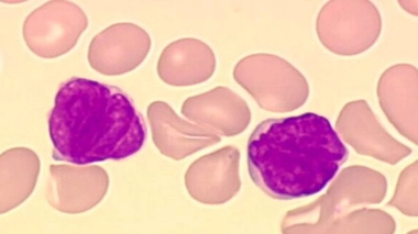 Le Yescarta doit traiter les lymphomes non hodgkiniens agressifs, une tumeur du système lymphatique