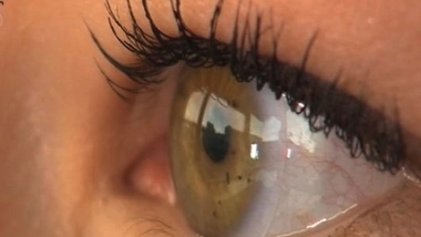 Le kératocône est une déformation de la cornée qui brouille la vue du malade (Image d'illustration)