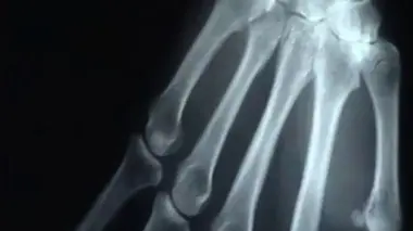 Ch@t : Tout savoir sur l'arthrose